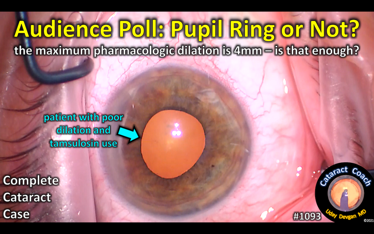 small pupil cataract surgery Cataract Coach