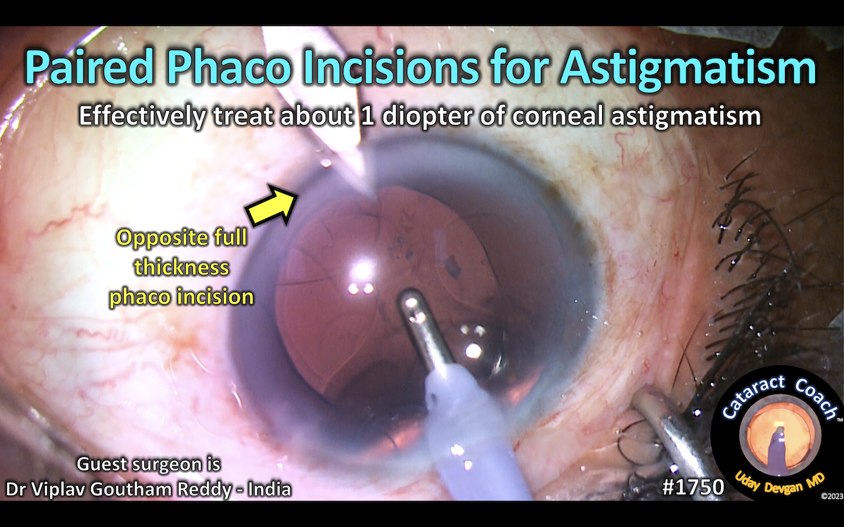 incisions – Cataract Coach™