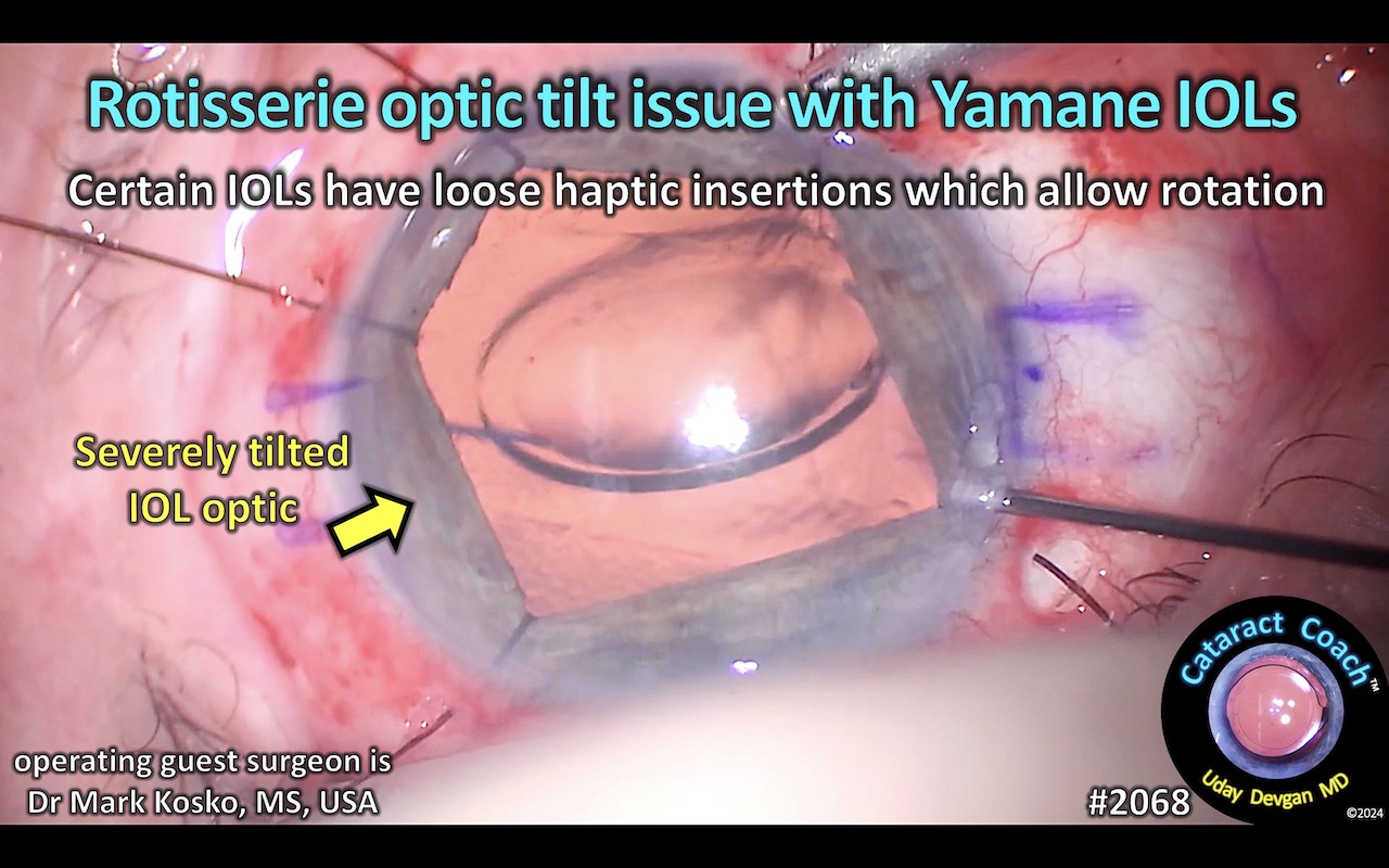 2068 IOL rotisserie optic tilt yamane – Cataract Coach™