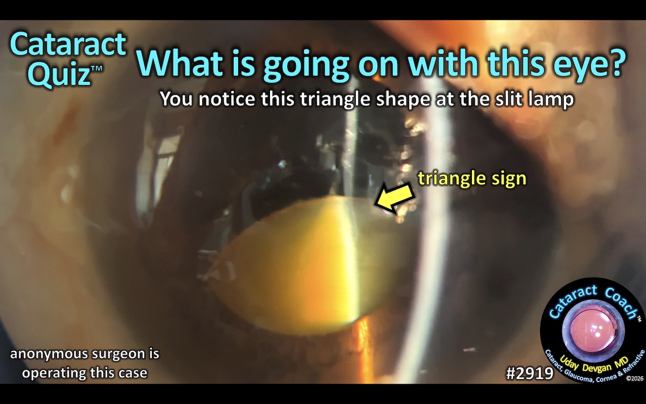 Recognizing the Triangle Sign in Morgagnian Cataracts